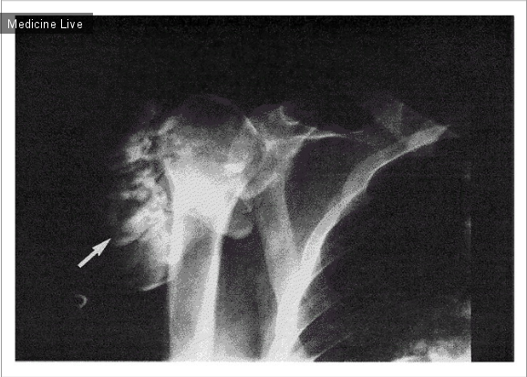 Интересный случай: Метастатическое обызвествление плечевой кости при хронической почечной недостаточности.