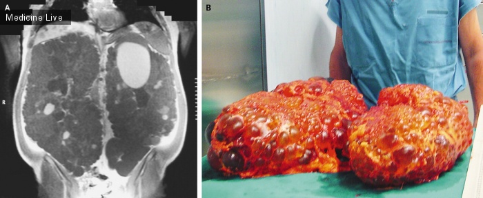 Интересный случай: Поликистоз почек