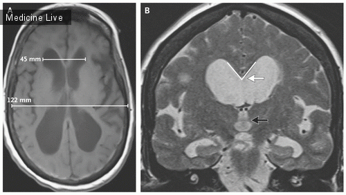 Интересный случай: Установка вентрикулоперитонеального шунта при нормотензивной гидроцефалии