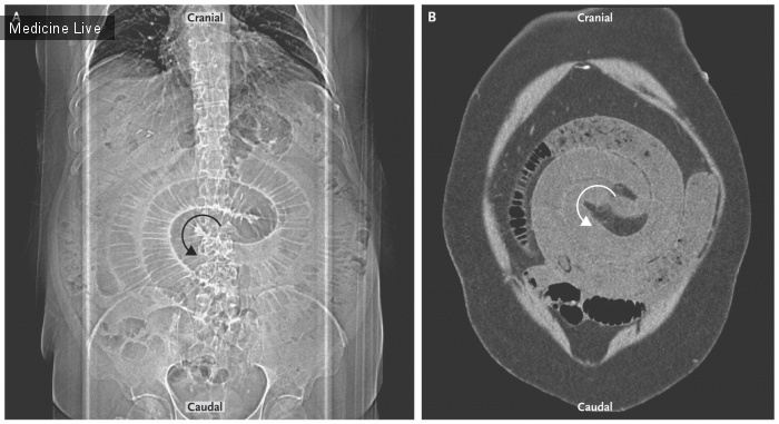 Интересный случай: Заворот кишок после шунтирования желудка с гастроеюноанастомозом по Ру