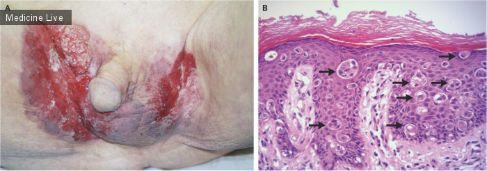 Интересный случай: Экстрамаммарная болезнь Паджета