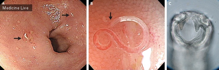 Интересный случай: Заражение кишечника Ancylostoma ceylanicum