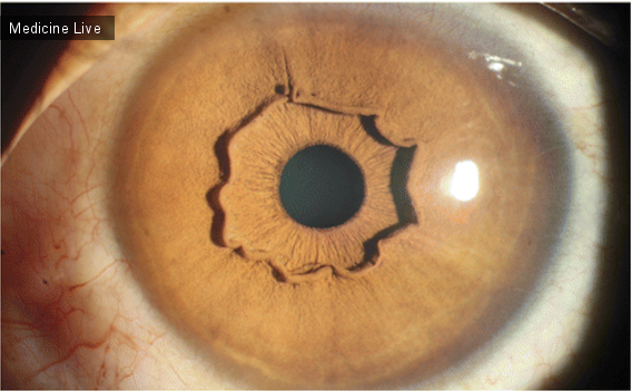 Интересный случай: Выдающийся зубчатый край радужки