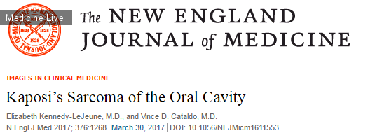 Интересный случай: Саркома Капоши полости рта
