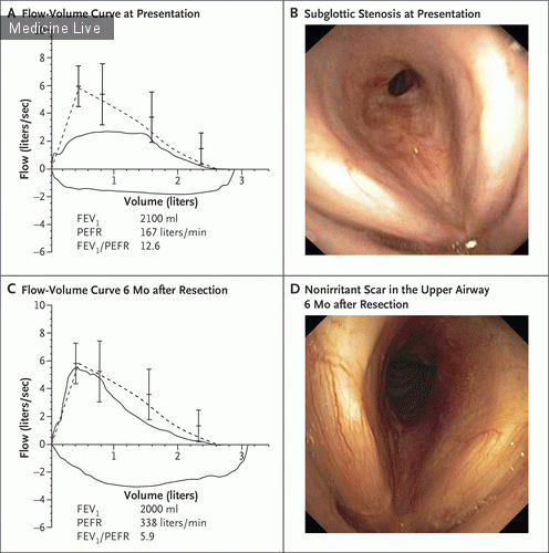 Интересный случай: Подгортанный стеноз