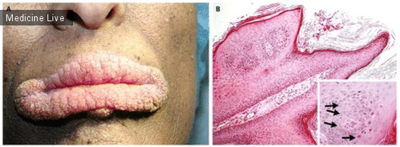 Интересный случай: Оральный черный акантоз