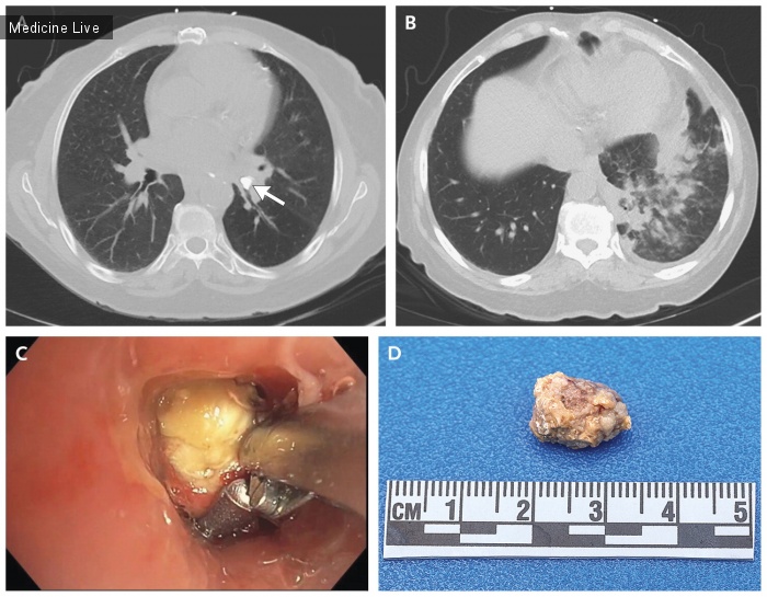 Интересный случай: Бронхоскопическое удаление обструктивного бронхолита