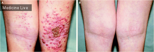 Интересный случай: Герпетическая экзема