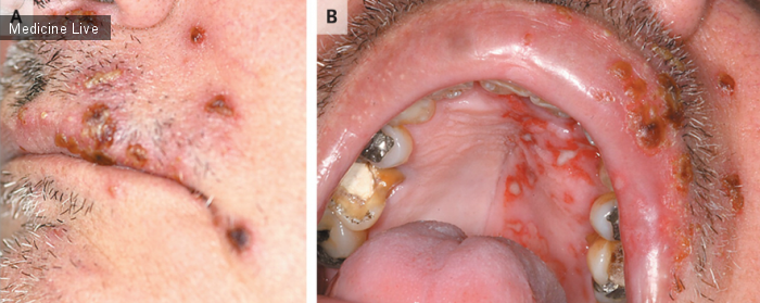 Интересный случай: Язвы ротовой полости.