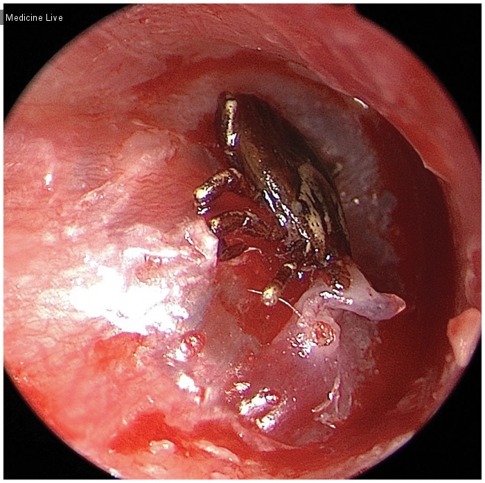 Интересный случай: Клещ прикрепляется к барабанной перепонке