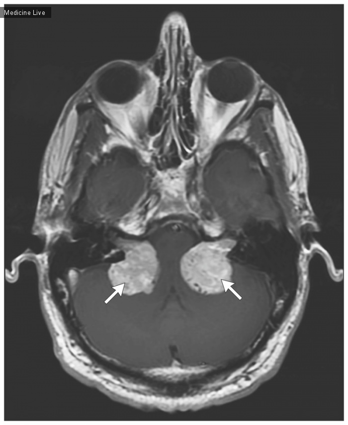 Интересный случай: Двусторонние вестибулярные шванномы при нейрофиброматозе 2 типа