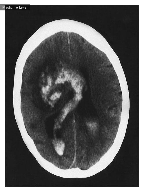 Интересный случай: Геморрагическая трансформация церебрального инфаркта