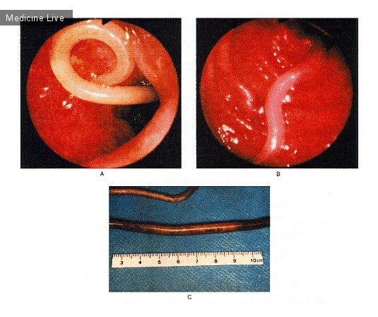 Интересный случай: Аскарида червеобразная