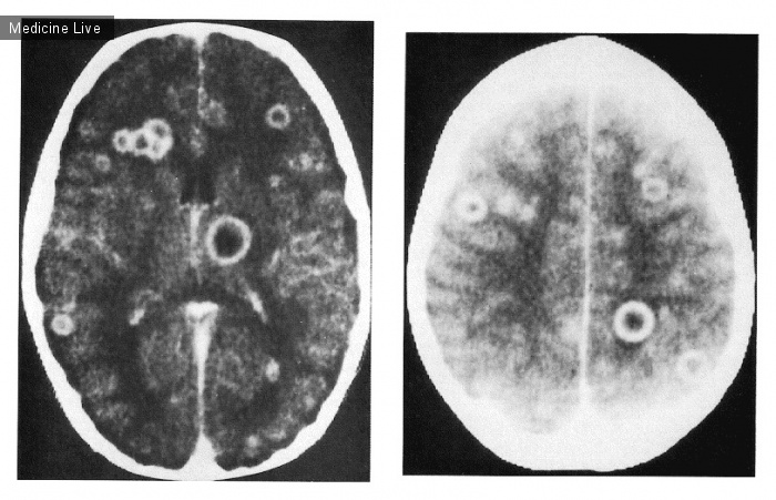 Интересный случай: Множественные абсцессы головного мозга