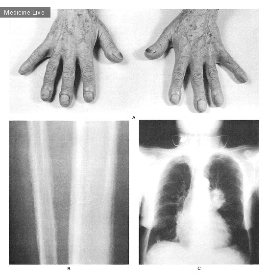 Интересный случай: Клубообразование и гипертрофическая остеоартропатия