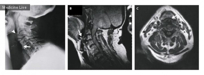 Интересный случай: Передние шейные остеофиты, вызывающие непроходимость дыхательных путей