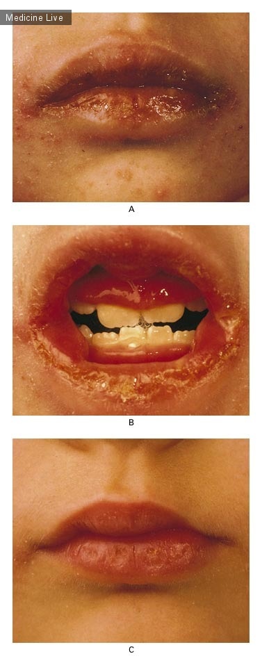 Интересный случай: Оральные проявления болезни Крона