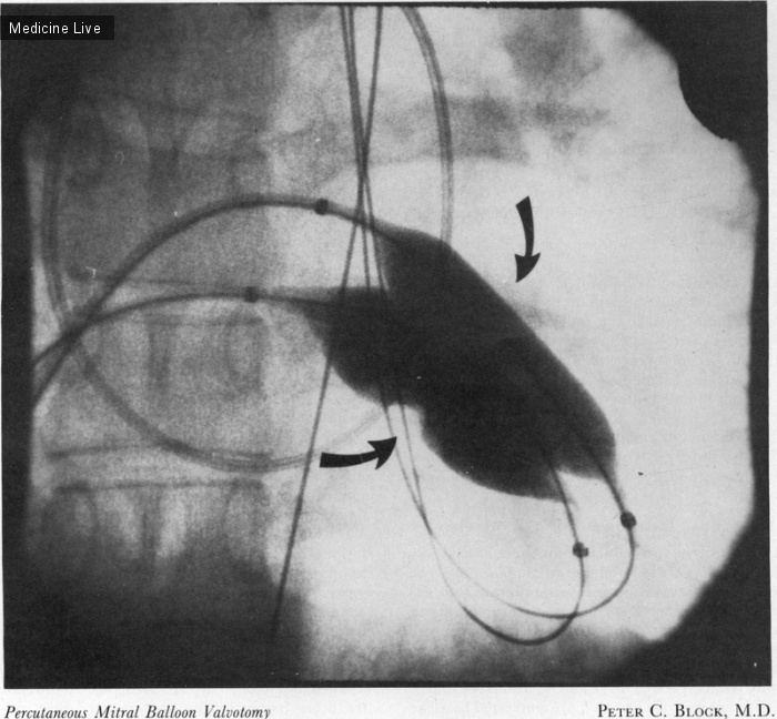 Интересный случай: Чрескожная митральная баллонная вальвулотомия
