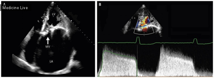 Интересный случай: Тяжелый митральный стеноз