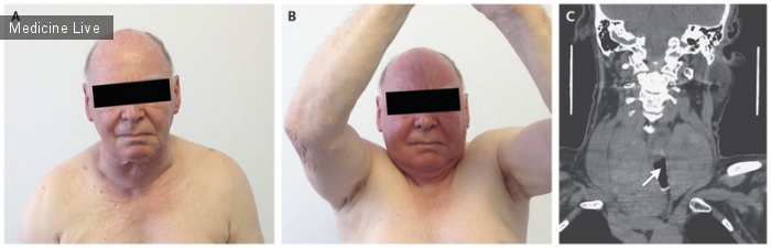 Интересный случай: Симптом Пембертона у пациента с зобом