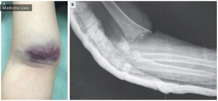 Интересный случай: Надмыщелковый перелом