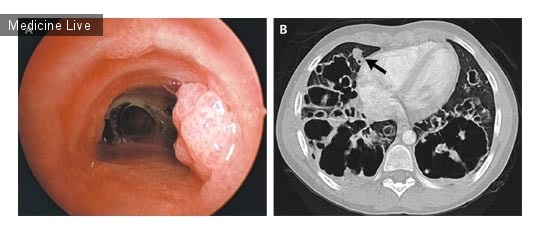 Интересный случай: Рецидивирующий папилломатоз с поражением легких