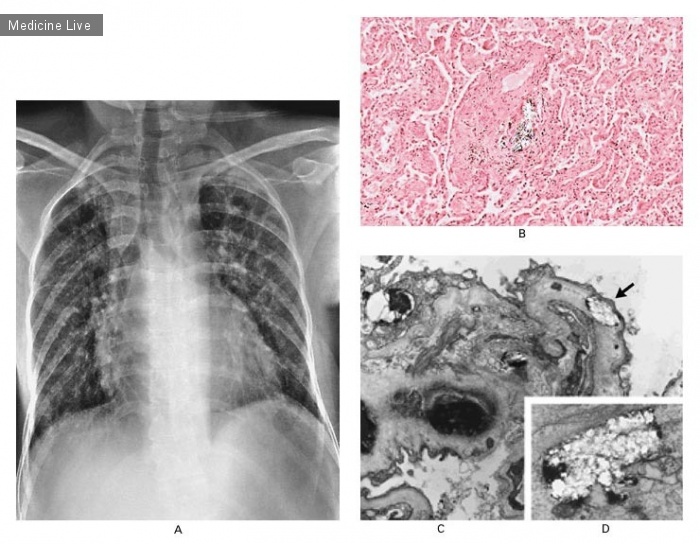 Интересный случай: Легочная гранулема у инъекционного наркомана