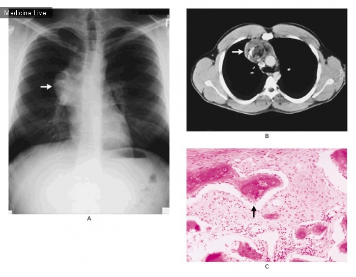 Интересный случай: Медиастинальная тератома