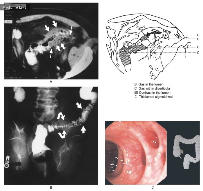 Интересный случай: Дивертикулит