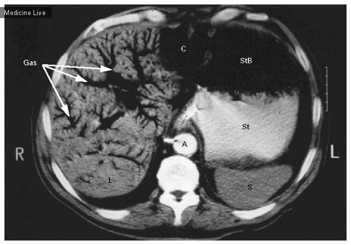 Интересный случай: Воздух в портальной венозной системе