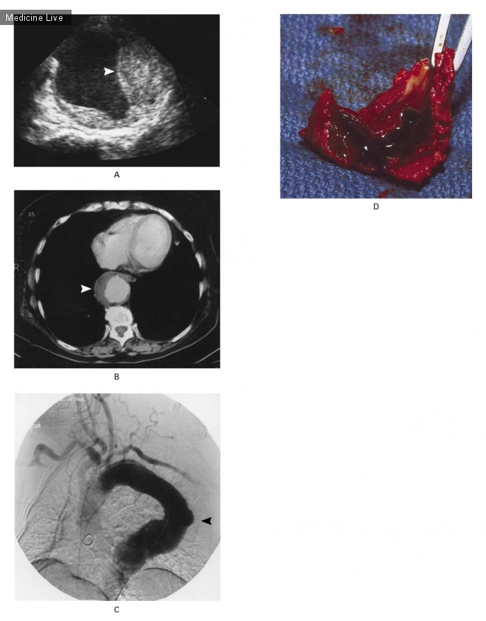 Интересный случай: Интрамуральная гематома аорты