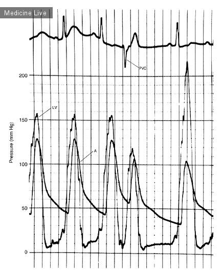 Интересный случай: Графики давления при обструктивной кардиомиопатии