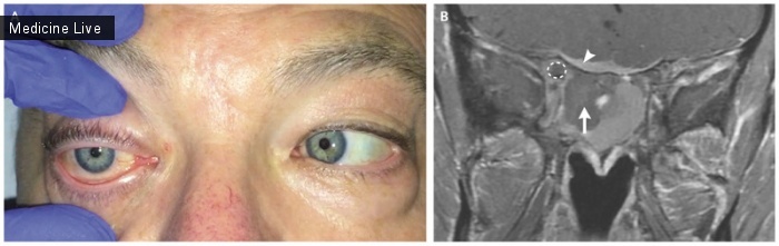 Интересный случай: Синдром верхушки орбиты