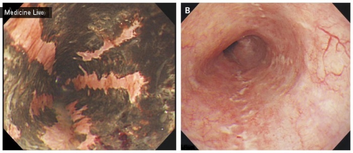 Интересный случай: Острый некроз пищевода