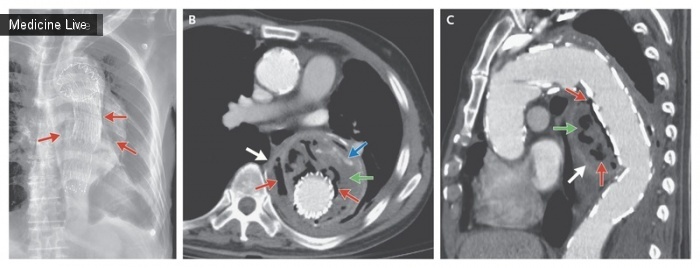 Интересный случай: Эмфизематозный аортит после эндоваскулярного протезирования