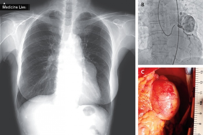 Интересный случай: Гигантская аневризма коронарной артерии