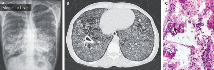 Интересный случай: Легочный альвеолярный микролитиаз, осложненный туберкулезом