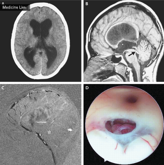 Интересный случай: Идиопатический стеноз водопровода мозга