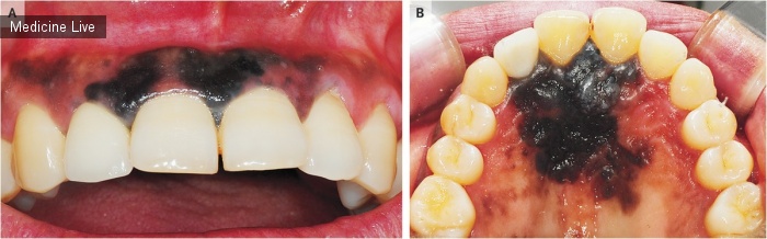 Интересный случай: Меланома ротовой полости