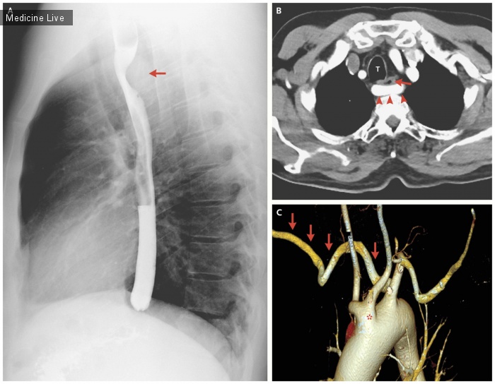 Интересный случай: Дисфагия Лузория