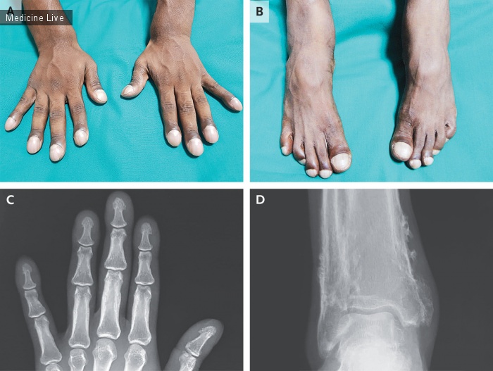 Интересный случай: Первичная гипертрофическая остеоартропатия