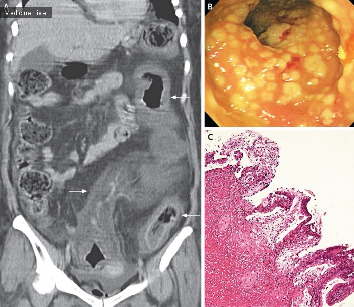 Интересный случай: Псевдомембранозный колит