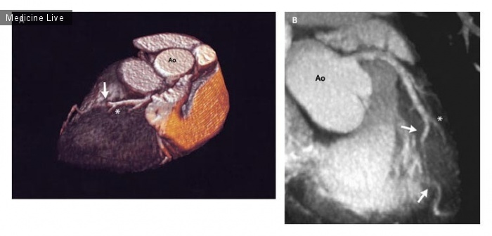 Интересный случай: Миокардиальный мостик