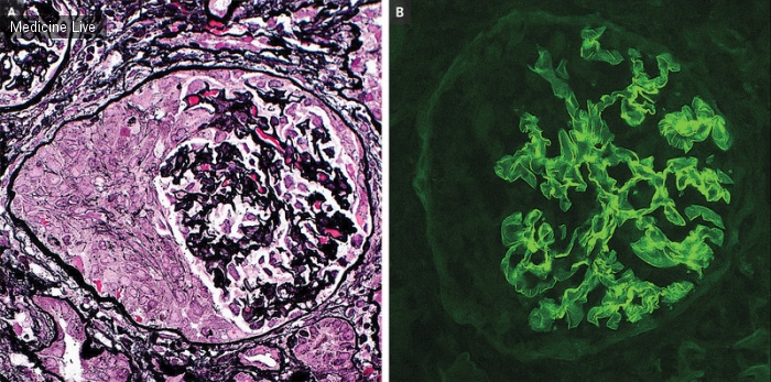 Интересный случай: Сочетание гломерулонефрита с антителами к гломерулярной базальной мембране