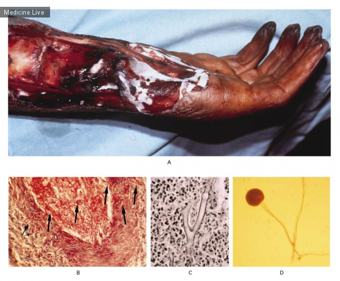 Интересный случай: Мукормикоз кисти и предплечья