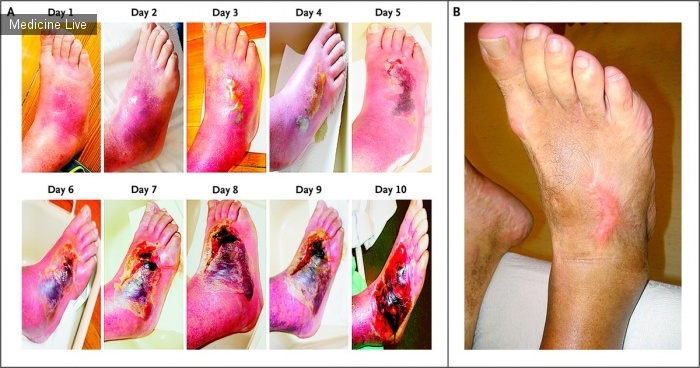 Интересный случай: Развитие инфекции диабетической стопы