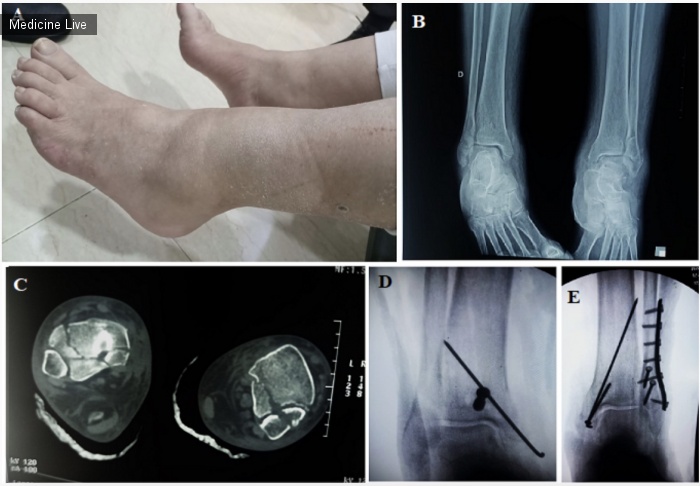 Интересный случай: Редкий случай двустороннего перелома лодыжки