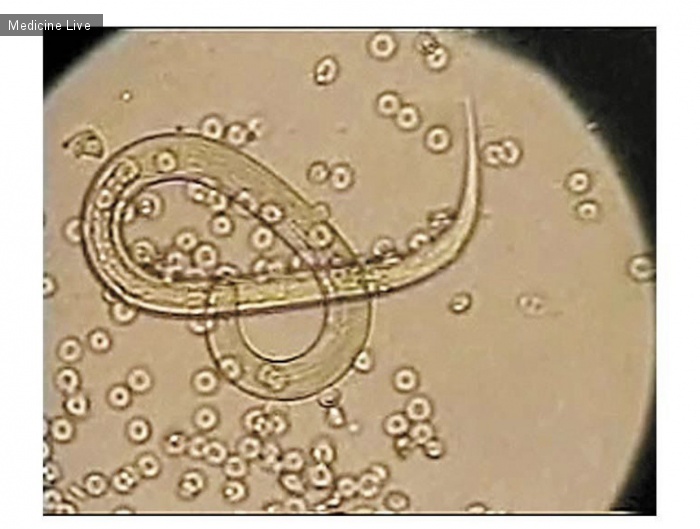 Интересный случай: Гиперинфекция Strongyloides stercoralis