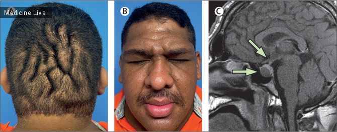 Интересный случай: Выступающие кожные складки скальпа дают поверхностную подсказку в нахождении акромегалии