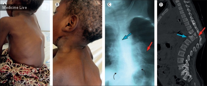 Интересный случай: Параплегия и деформация позвоночника у мозамбикского ребенка с болезнью Потта и туберкулезной золотухой